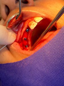 ایمپلنت‌های دندانی