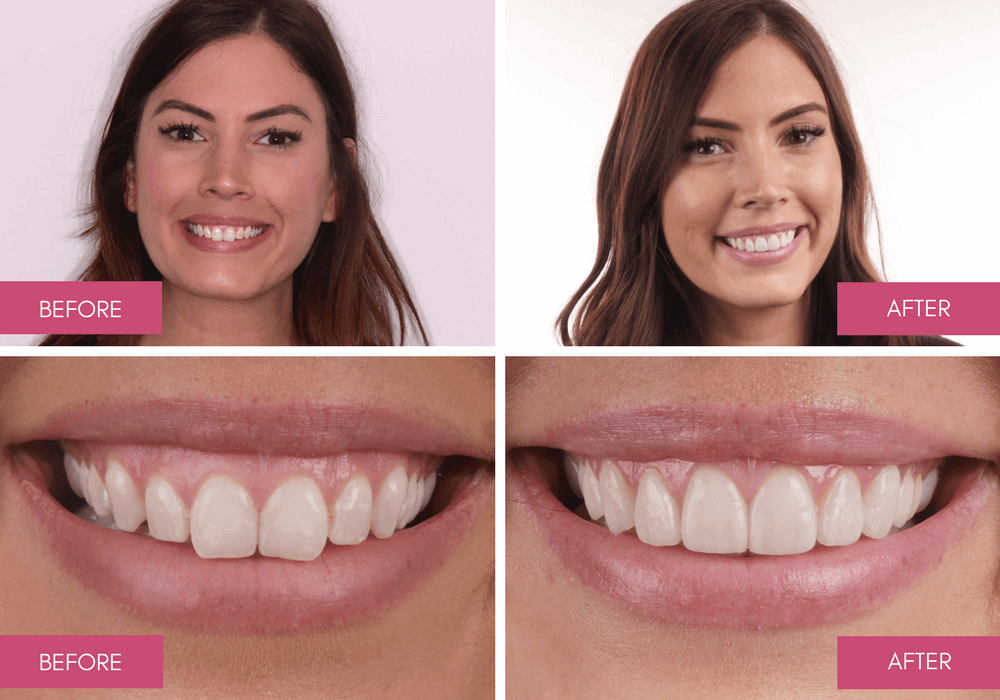 درمان های زیبایی لثه در بیماران با خنده لثه ای یا gummy smile دکتر